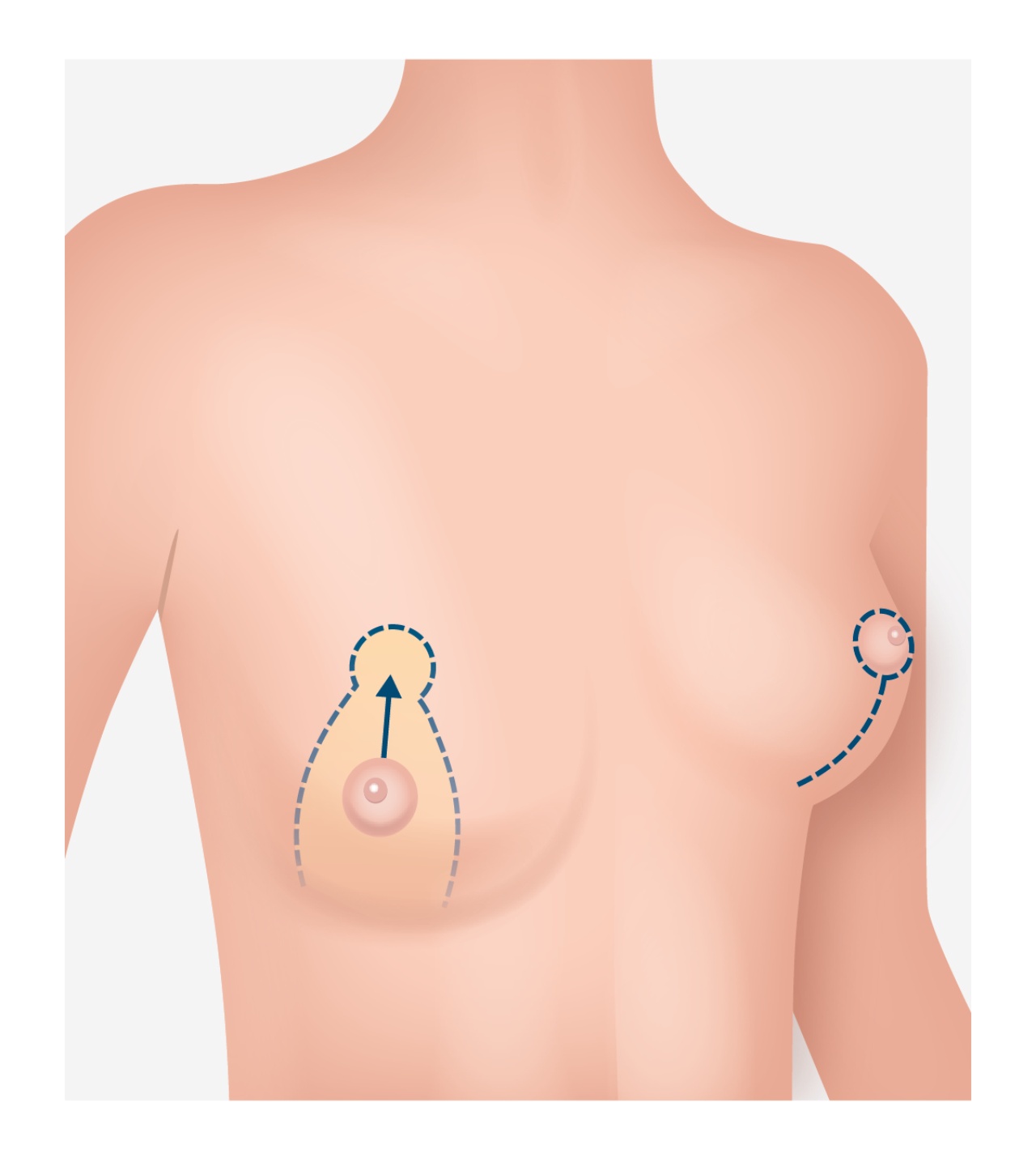 Illustration einer Brustwarzen Operation