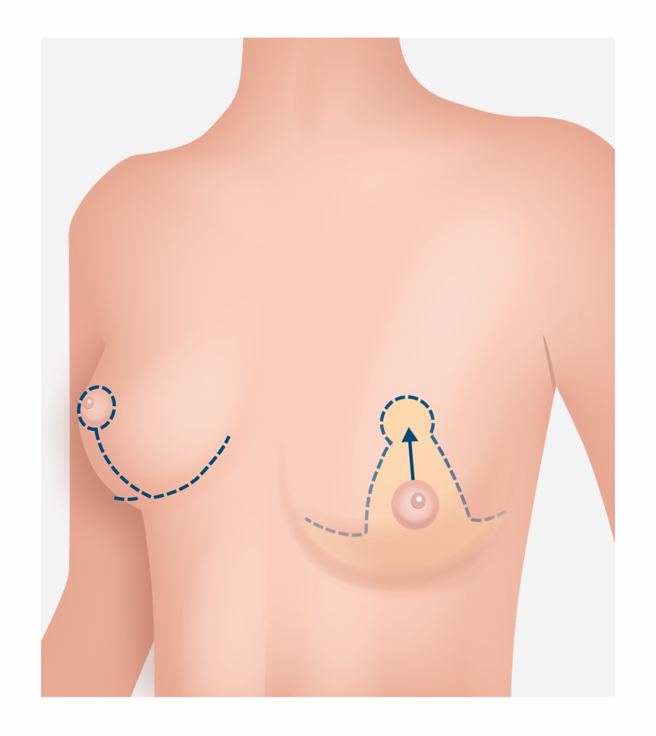 Illustration einer Brustwarzen Operation